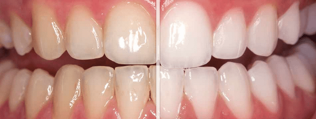 Teeth Whitening Before and After in Chapel Hill