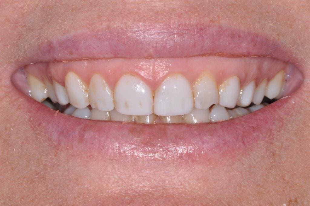 Chapel Hill Cosmetic and Family Dentistry before cosmetic dentistry