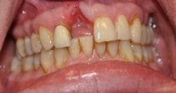 Before Receiving Partial Denture in Chapel Hill NC Dentist Office