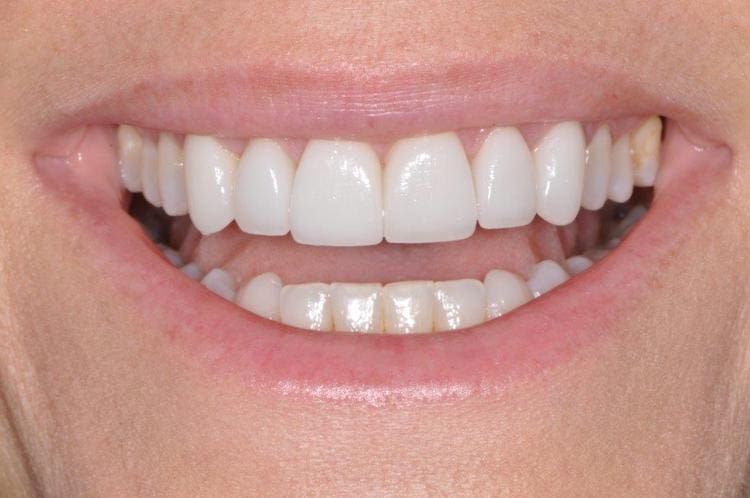 Chapel Hill Cosmetic and Family Dentistry after cosmetic dentistry