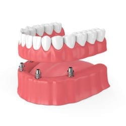 Who Can Benefit From Implant-Secured Dentures?