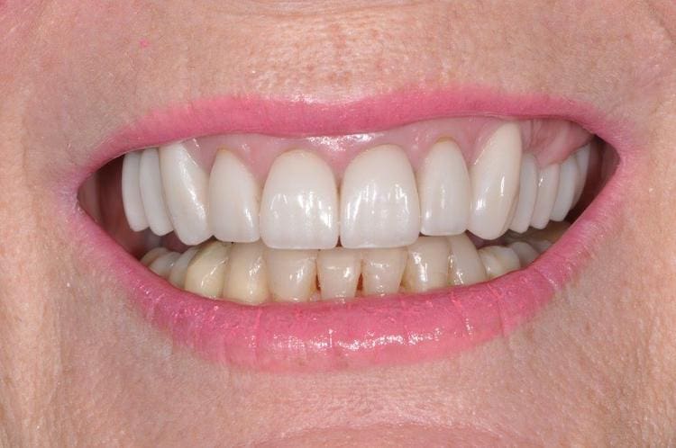 After dental crown restoration