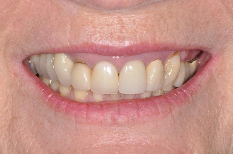 Before dental crown restoration