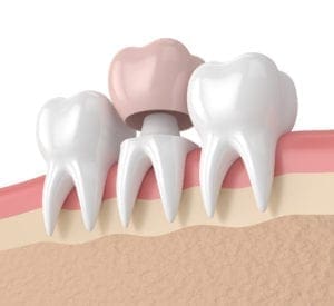 3d render of teeth in gums with dental crown restoration
