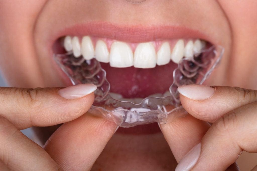 Invisalign in Durham North Carolina