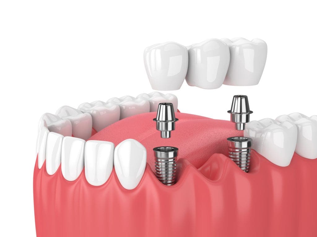 Cost of Dental Implants Chapel Hill NC
