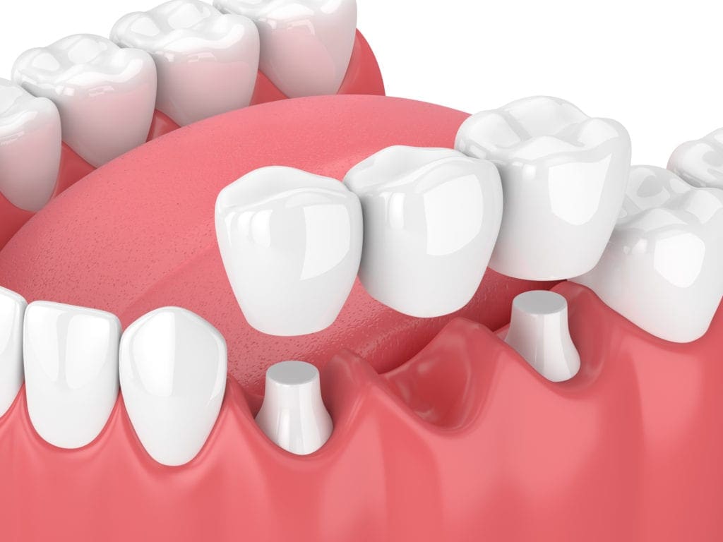 dental bridge treatment in Durham North Carolina