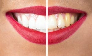 teeth whitening chapel hill north carolina