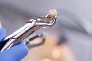chapel hill dentist tooth extraction