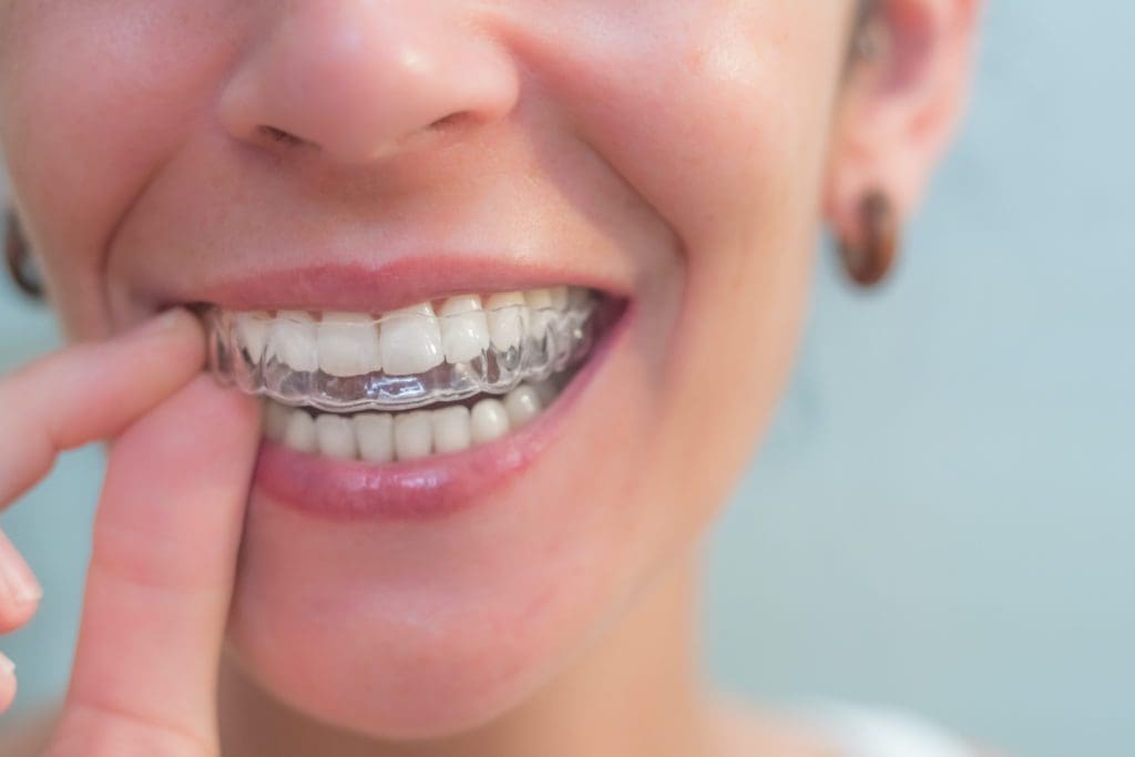 invisalign treatment versus braces