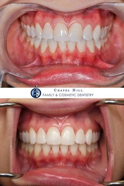 Before and after dental services at Chapel Hill Family & Cosmetic Dentistry