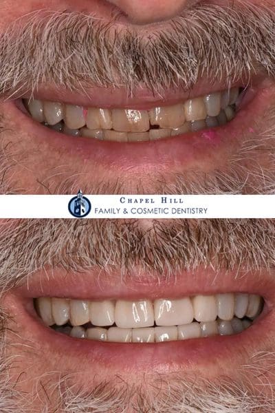 Before and after dental services at Chapel Hill Family & Cosmetic Dentistry