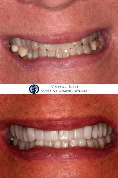 Before and after dental services at Chapel Hill Family & Cosmetic Dentistry