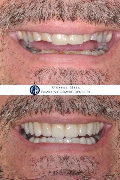 Before and after dental services at Chapel Hill Family & Cosmetic Dentistry