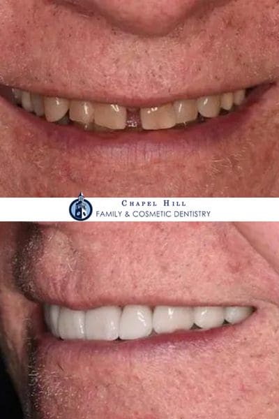 Before and after dental services at Chapel Hill Family & Cosmetic Dentistry