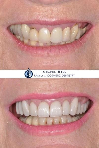 Before and after dental services at Chapel Hill Family & Cosmetic Dentistry