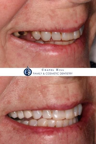 Before and after dental services at Chapel Hill Family & Cosmetic Dentistry