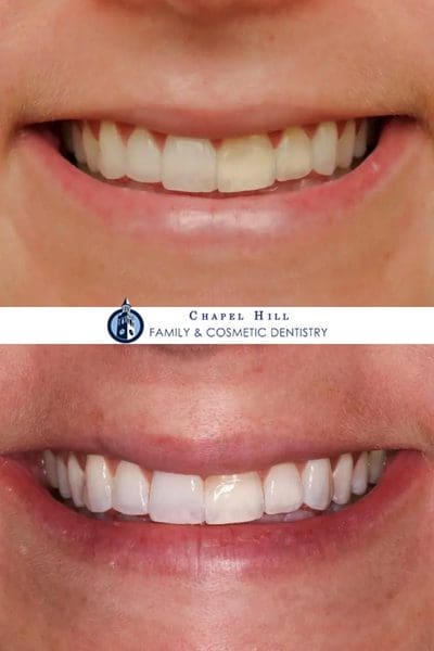 Before and after dental services at Chapel Hill Family & Cosmetic Dentistry