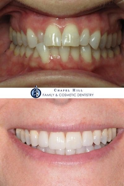 Before and after dental services at Chapel Hill Family & Cosmetic Dentistry