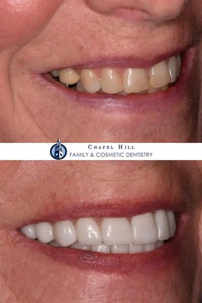 Before and after dental services at Chapel Hill Family & Cosmetic Dentistry