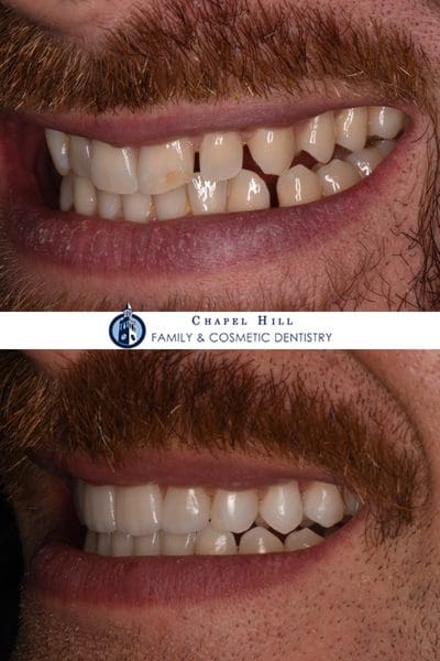 Before and after dental services at Chapel Hill Family & Cosmetic Dentistry