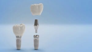 Dental Implants in Chapel Hill, NC