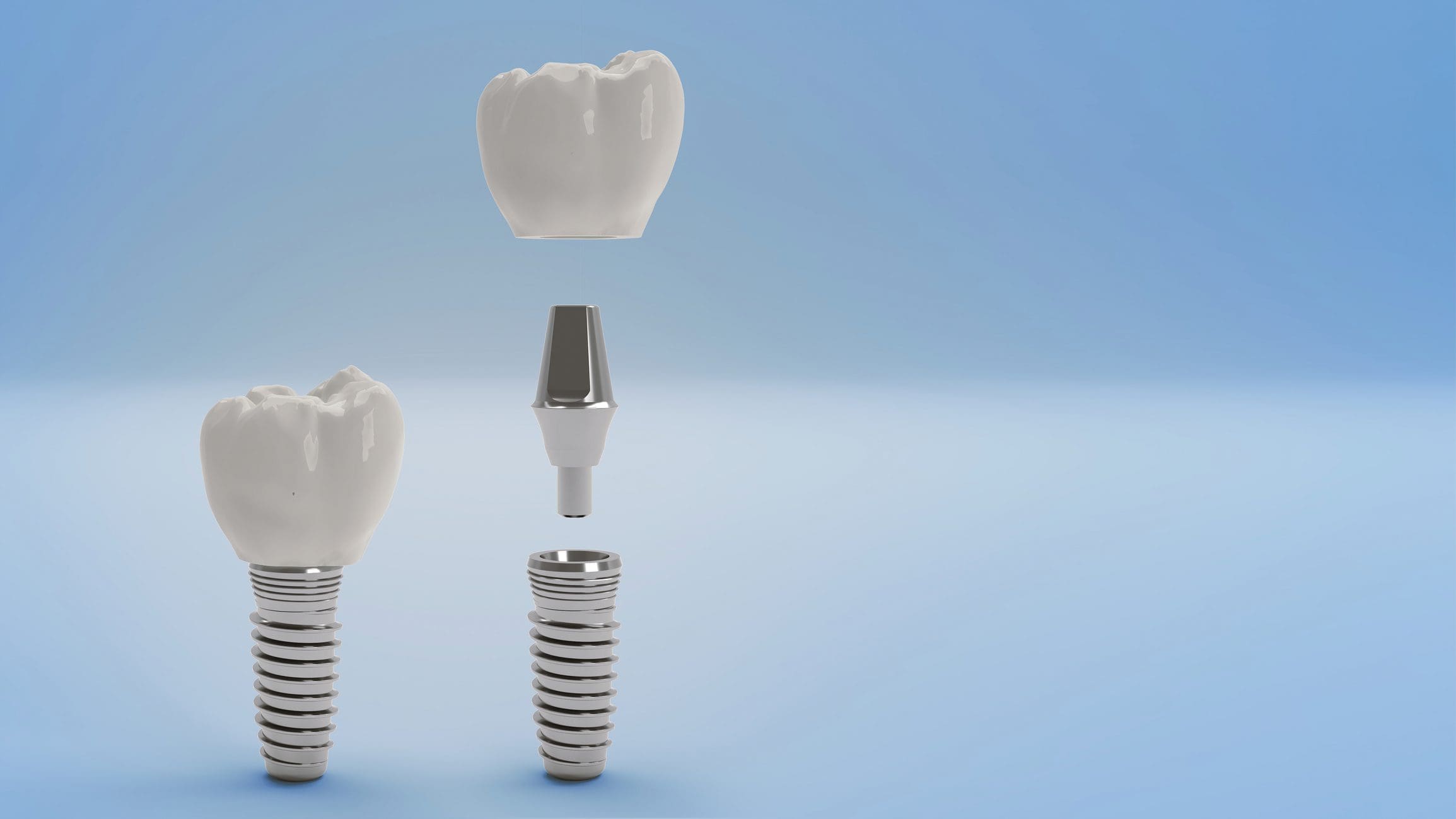 What If Your Implant Crown Comes Loose? A Chapel Hill Patient's Guide