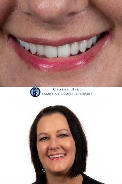 Dentistry results at Chapel Hill Family & Cosmetic Dentistry