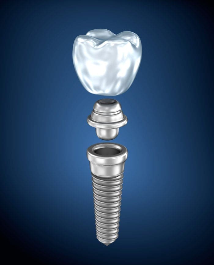 The Components of a Dental Implant