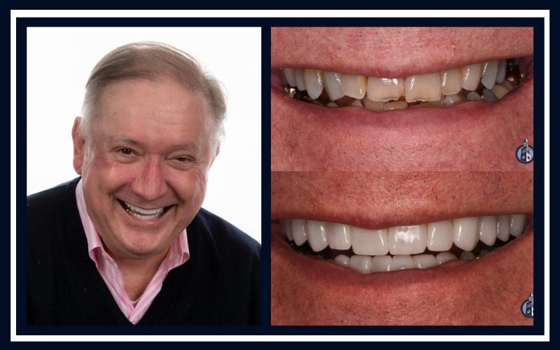 Timeline for Dental Implants