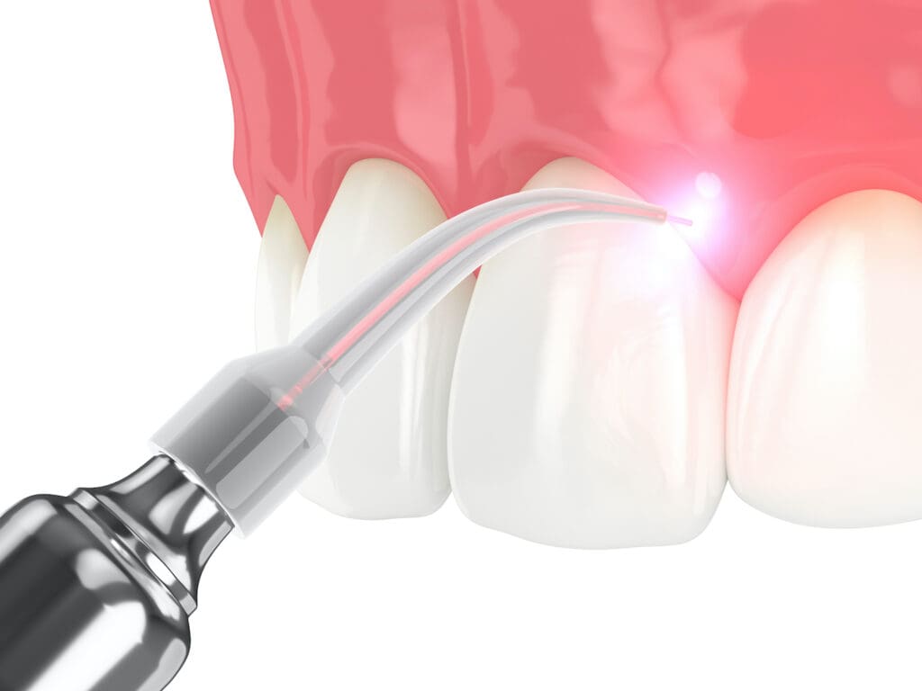 LASER DENTISTRY in Chapel Hill NC is a safe and effective way to treat soft-tissue dental problems