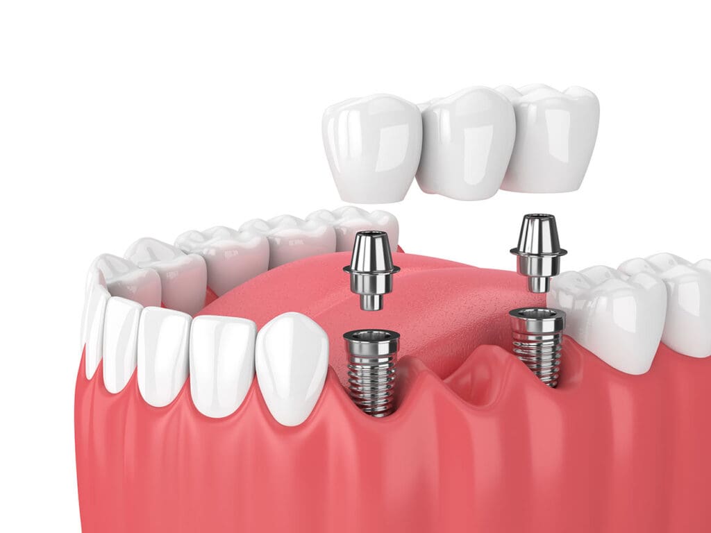 A dental bridge replaces missing teeth and could help improve your smile, bite strength, and jaw functionality.
