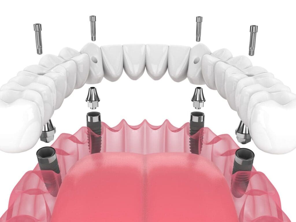 All-on-4 implants, or Teeth-in-a-Day