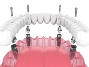 All-on-4 implants, or Teeth-in-a-Day