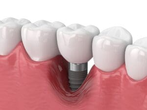 Dental implant with crown restoration