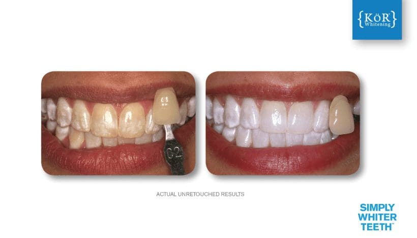 cosmetic teeth whitening in chapel hill nc
