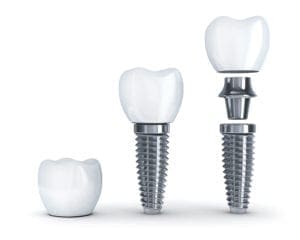 dental implants durham nc