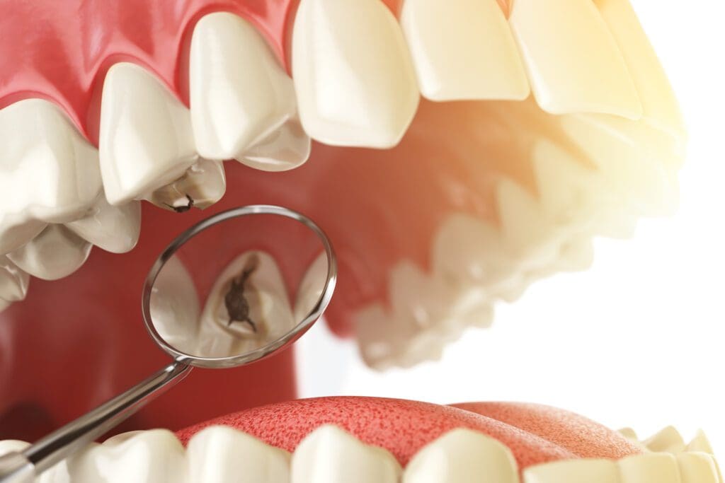 dental fillings in Chapel Hill, NC